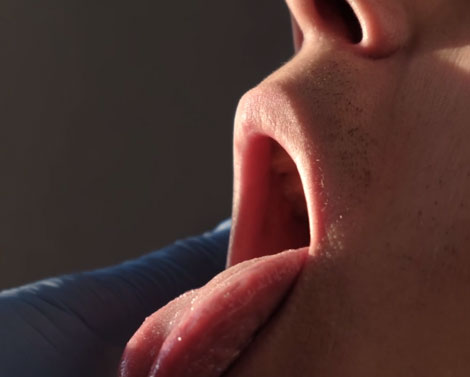 Spots on Tongue